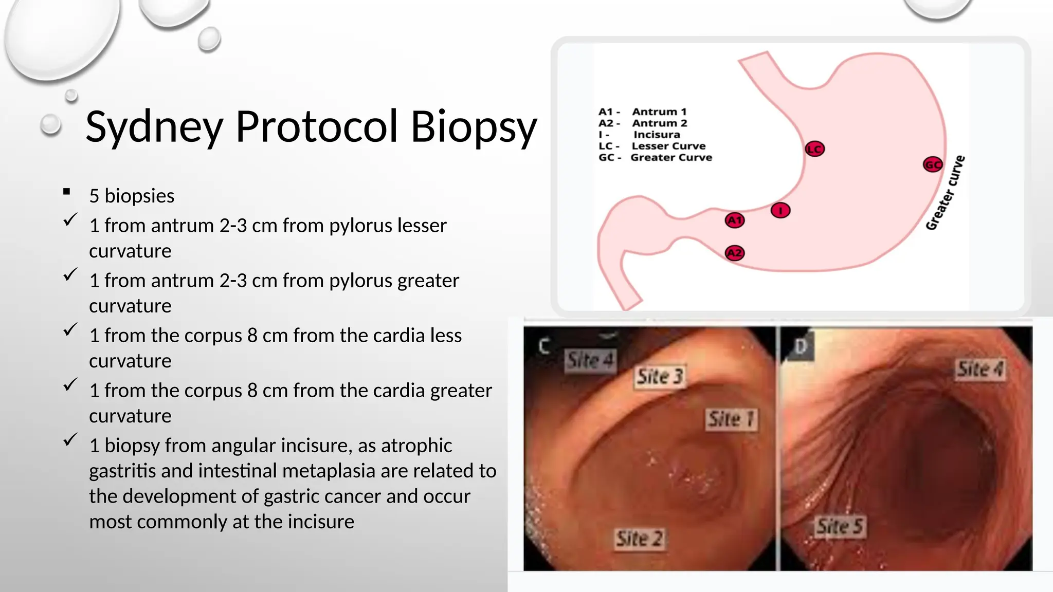 Sydney Protocol Biopsy
 5 biopsies
 1 from antrum 2-3 cm from pylorus lesser
curvature
 1 from antrum 2-3 cm from pylorus greater
curvature
 1 from the corpus 8 cm from the cardia less
curvature
 1 from the corpus 8 cm from the cardia greater
curvature
 1 biopsy from angular incisure, as atrophic
gastritis and intestinal metaplasia are related to
the development of gastric cancer and occur
most commonly at the incisure
 