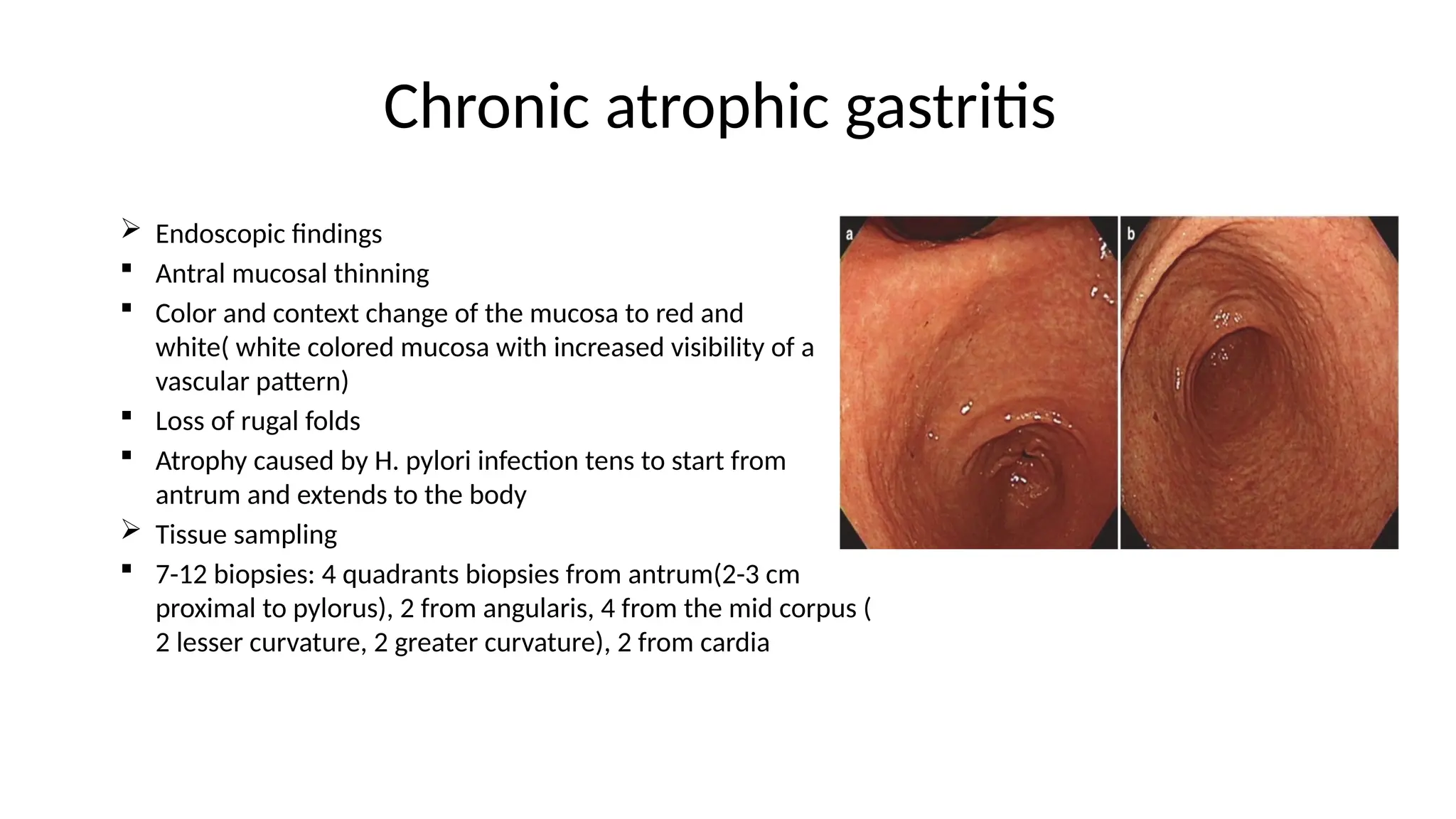 Chronic atrophic gastritis
 Endoscopic findings
 Antral mucosal thinning
 Color and context change of the mucosa to red and
white( white colored mucosa with increased visibility of a
vascular pattern)
 Loss of rugal folds
 Atrophy caused by H. pylori infection tens to start from
antrum and extends to the body
 Tissue sampling
 7-12 biopsies: 4 quadrants biopsies from antrum(2-3 cm
proximal to pylorus), 2 from angularis, 4 from the mid corpus (
2 lesser curvature, 2 greater curvature), 2 from cardia
 