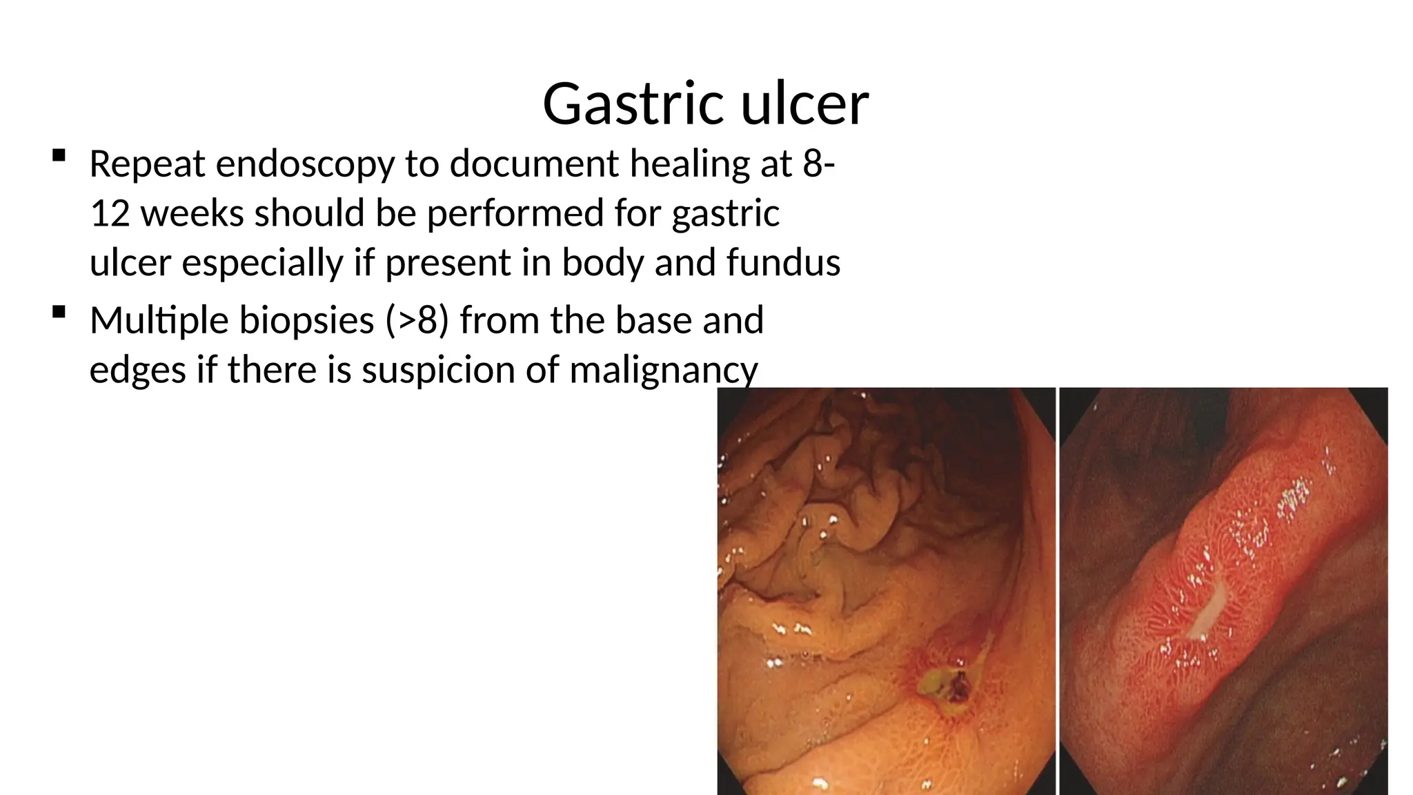 Gastric ulcer
 Repeat endoscopy to document healing at 8-
12 weeks should be performed for gastric
ulcer especially if present in body and fundus
 Multiple biopsies (>8) from the base and
edges if there is suspicion of malignancy
 