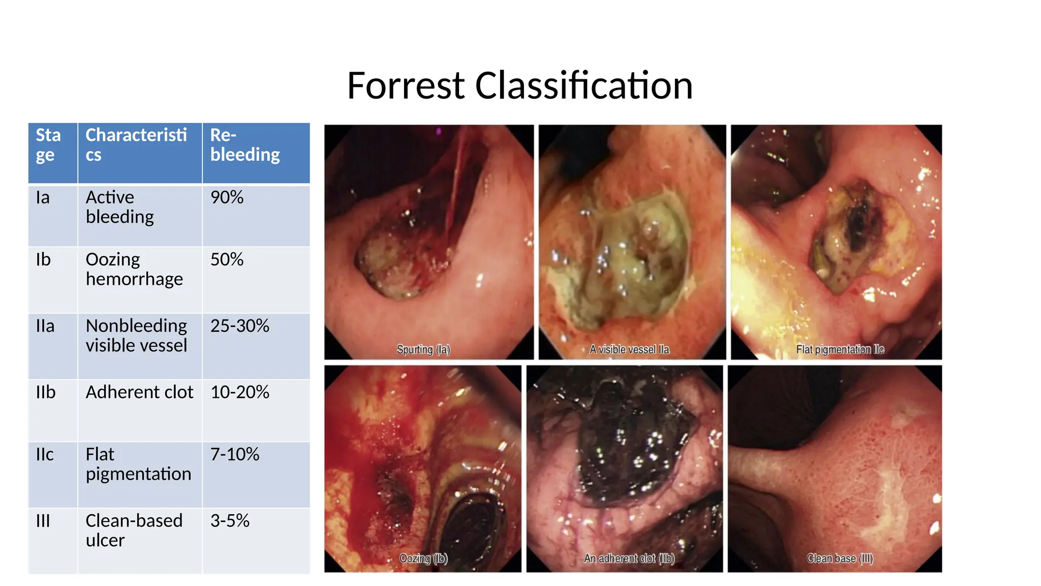 Forrest Classification
Sta
ge
Characteristi
cs
Re-
bleeding
Ia Active
bleeding
90%
Ib Oozing
hemorrhage
50%
IIa Nonbleeding
visible vessel
25-30%
IIb Adherent clot 10-20%
IIc Flat
pigmentation
7-10%
III Clean-based
ulcer
3-5%
 