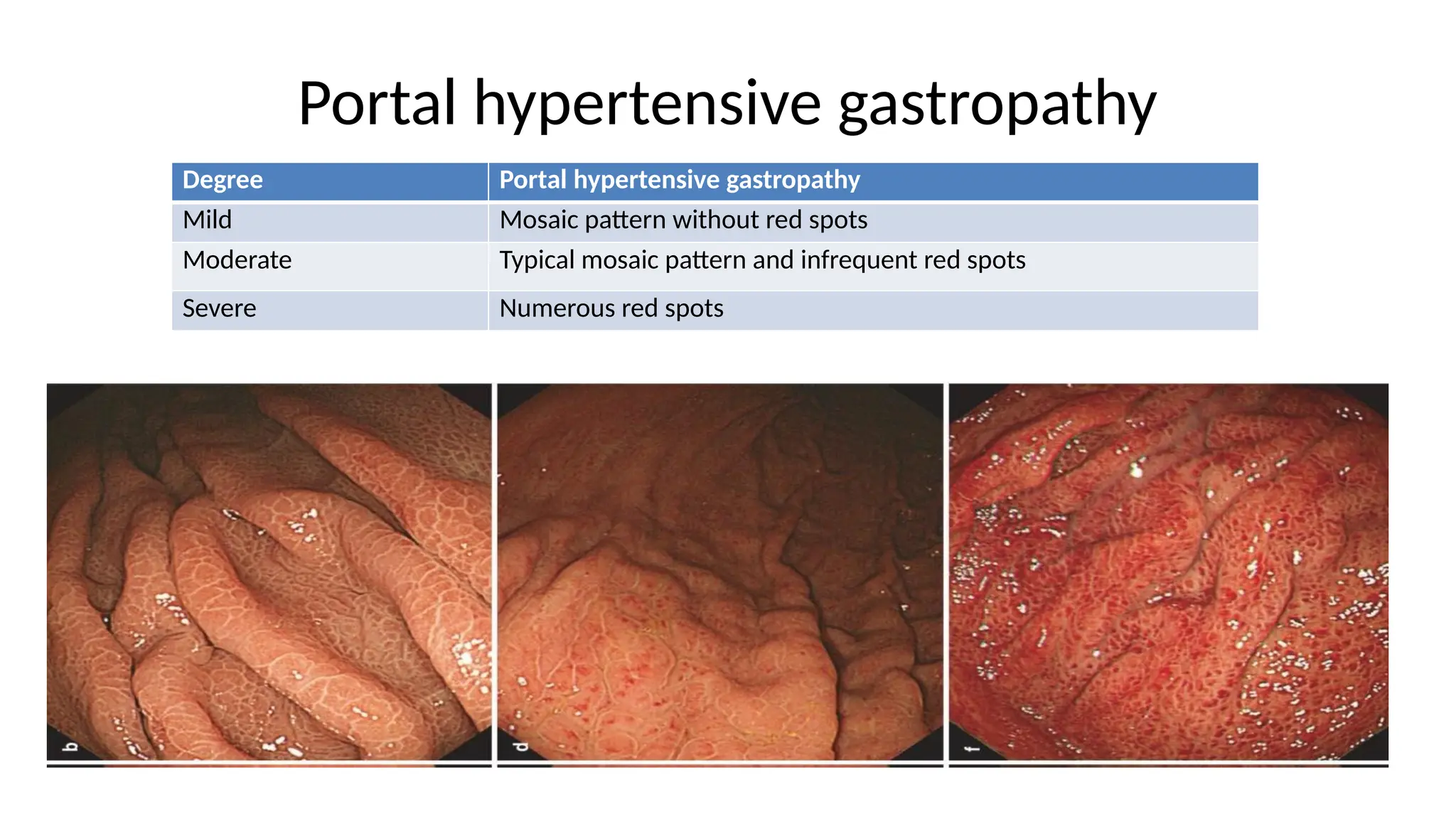 Portal hypertensive gastropathy
Degree Portal hypertensive gastropathy
Mild Mosaic pattern without red spots
Moderate Typical mosaic pattern and infrequent red spots
Severe Numerous red spots
 