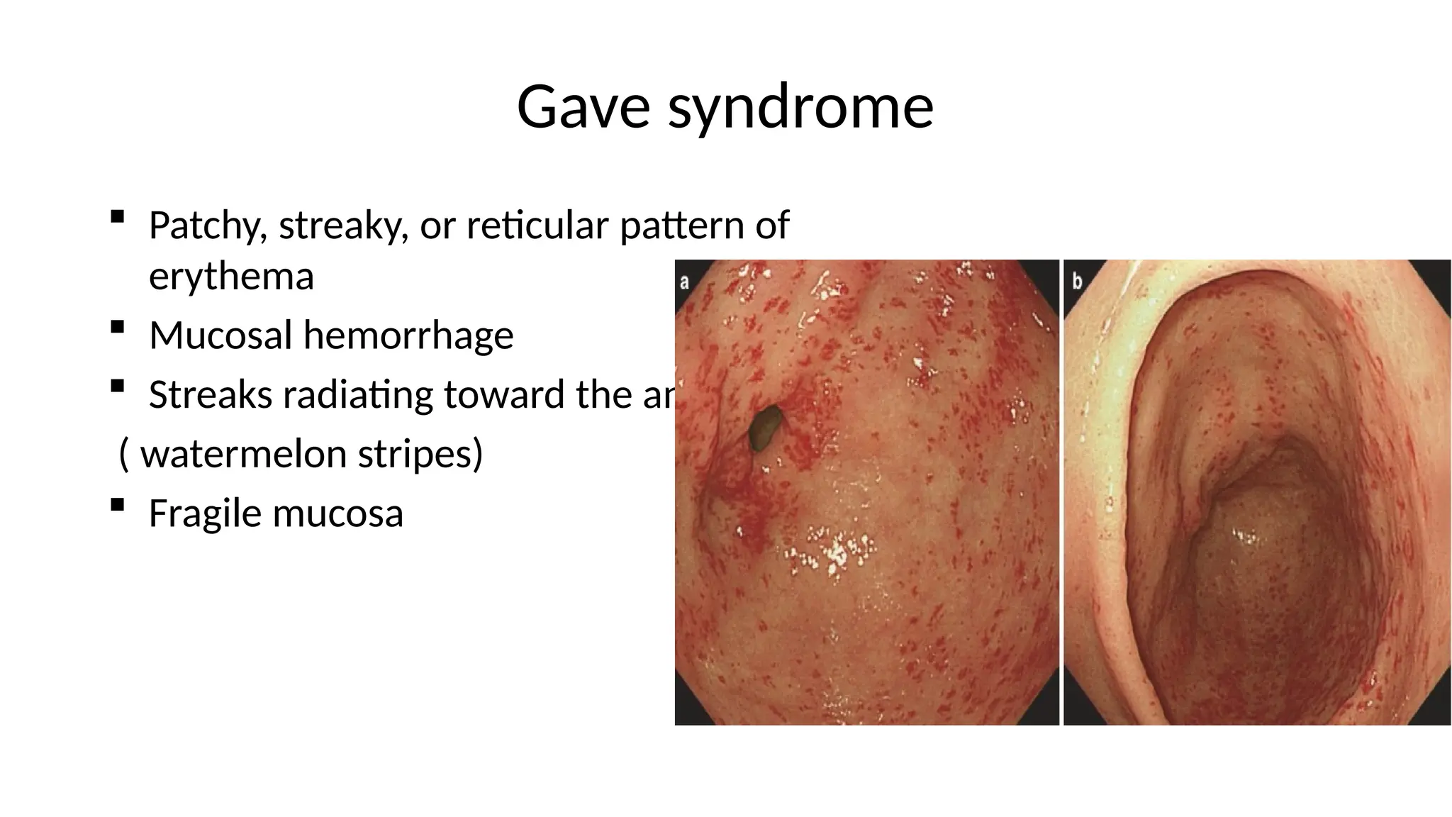 Gave syndrome
 Patchy, streaky, or reticular pattern of
erythema
 Mucosal hemorrhage
 Streaks radiating toward the antrum
( watermelon stripes)
 Fragile mucosa
 