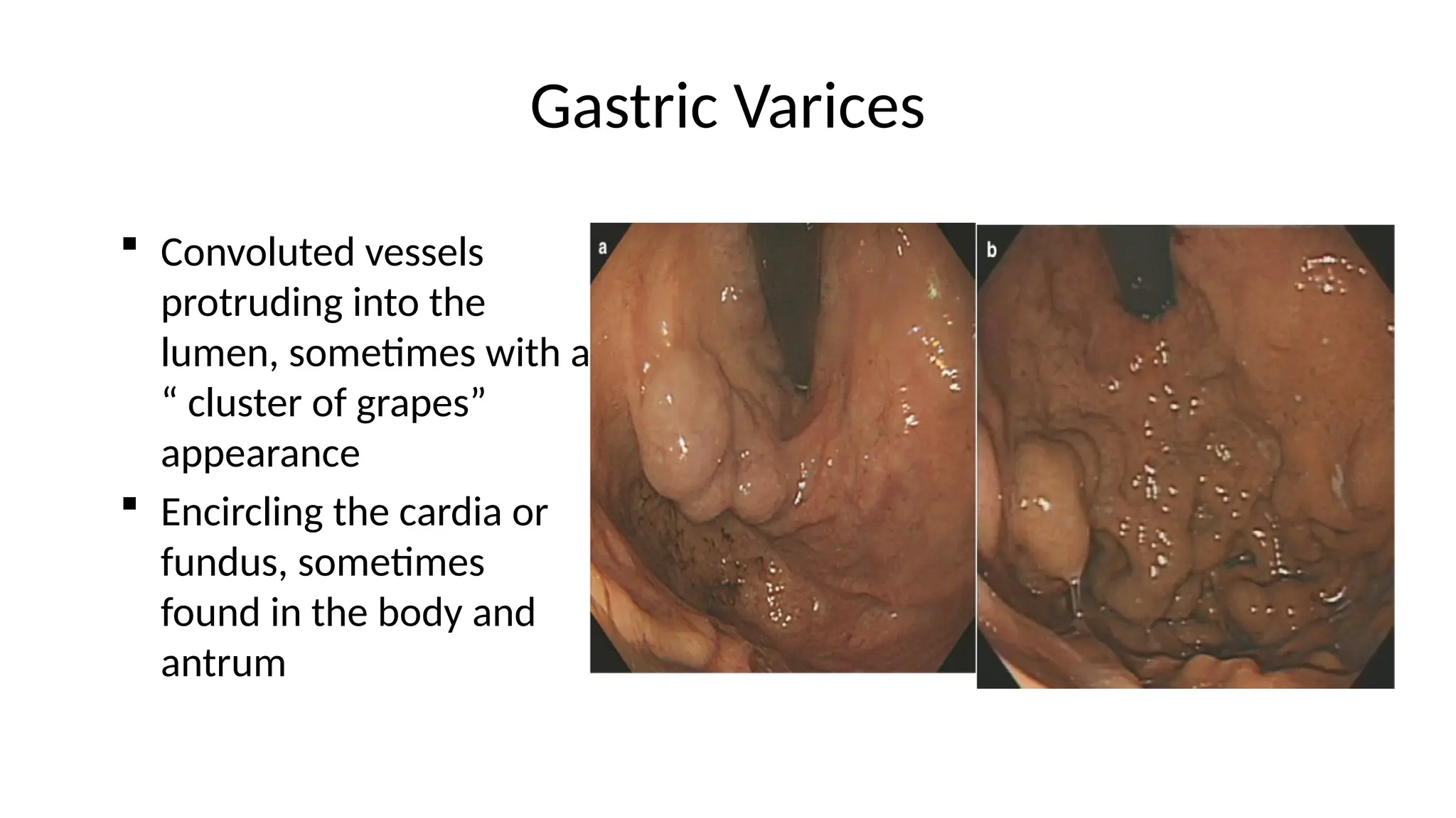 Gastric Varices
 Convoluted vessels
protruding into the
lumen, sometimes with a
“ cluster of grapes”
appearance
 Encircling the cardia or
fundus, sometimes
found in the body and
antrum
 