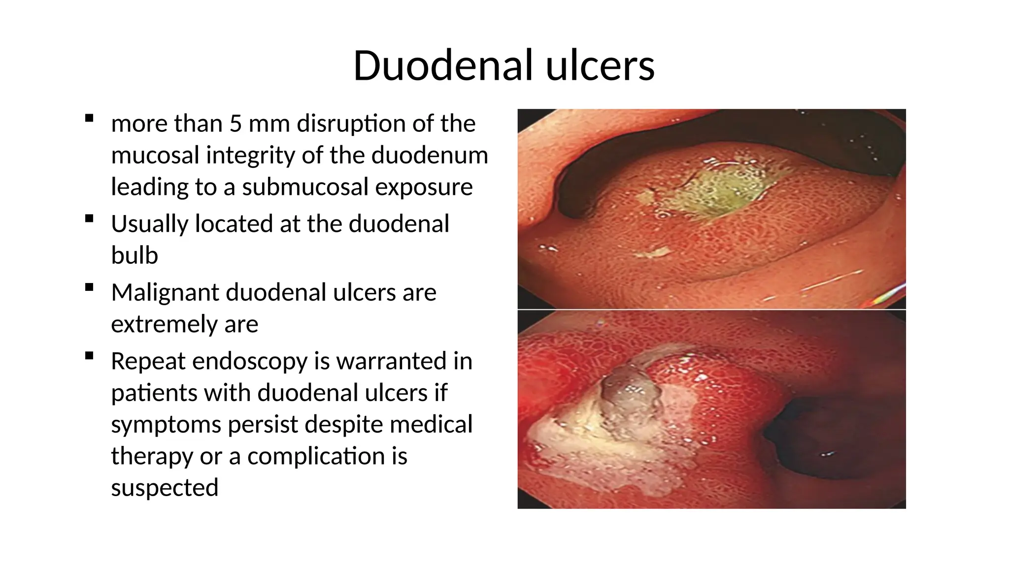 Duodenal ulcers
 more than 5 mm disruption of the
mucosal integrity of the duodenum
leading to a submucosal exposure
 Usually located at the duodenal
bulb
 Malignant duodenal ulcers are
extremely are
 Repeat endoscopy is warranted in
patients with duodenal ulcers if
symptoms persist despite medical
therapy or a complication is
suspected
 