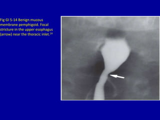 5 esophageal narrowing | PPTX