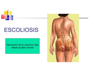 ESCOLIOSIS
Desviación de la columna vista
desde el plano frontal
 