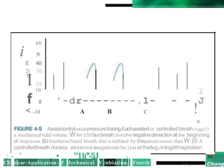 60
i 50
E 40
s 30
I!!
i
I 20
10
f 0 '-dr--------.1- - - J
< -10 A B C !
g
FIGURE 4-S Assisi/controlmodepressuretracing.EachassistedOf controlled bleath1rigge15
a mecharucal tidal volume. WAn i1551Stedbreath;notethe negativedenectionat the beginning
of inspraoon.(BJAnotheras5isted breath that is inillated by thepatientsooner than W (0 A
controlledbreath:nocethe absence anegativede!lec1ion at thelleg,nnlngorinspiration.
; - ,' • "11(''-!iJ 'l .
Cli_nicar-Application-of·Mechanical Venbiation, Fourth I •
 