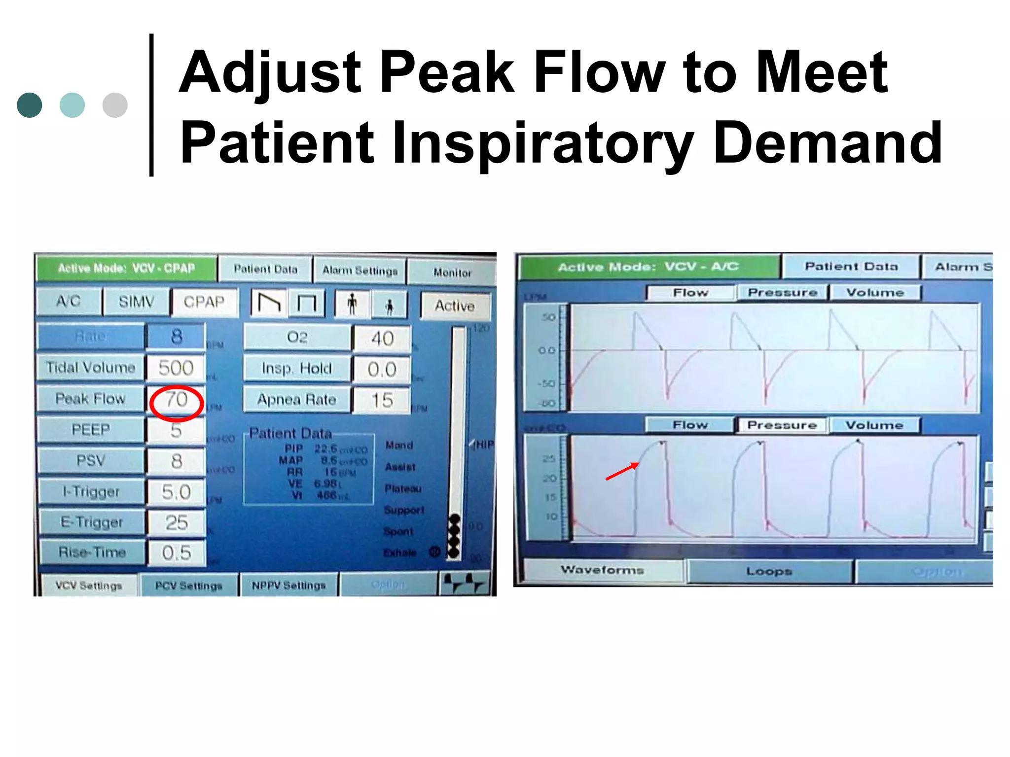 Adjust Peak Flow to Meet
Patient Inspiratory Demand
 