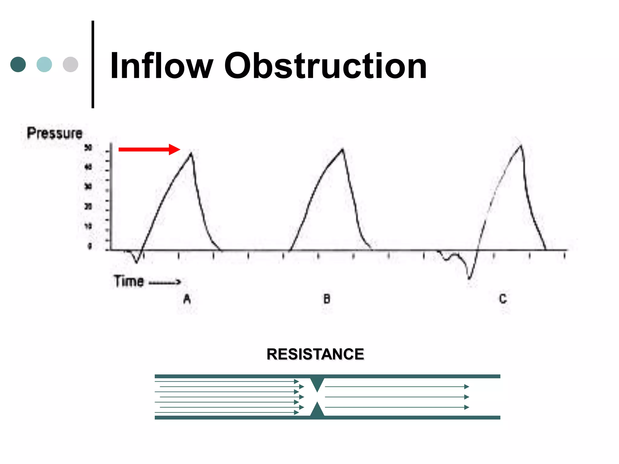 Inflow Obstruction
RESISTANCE
 