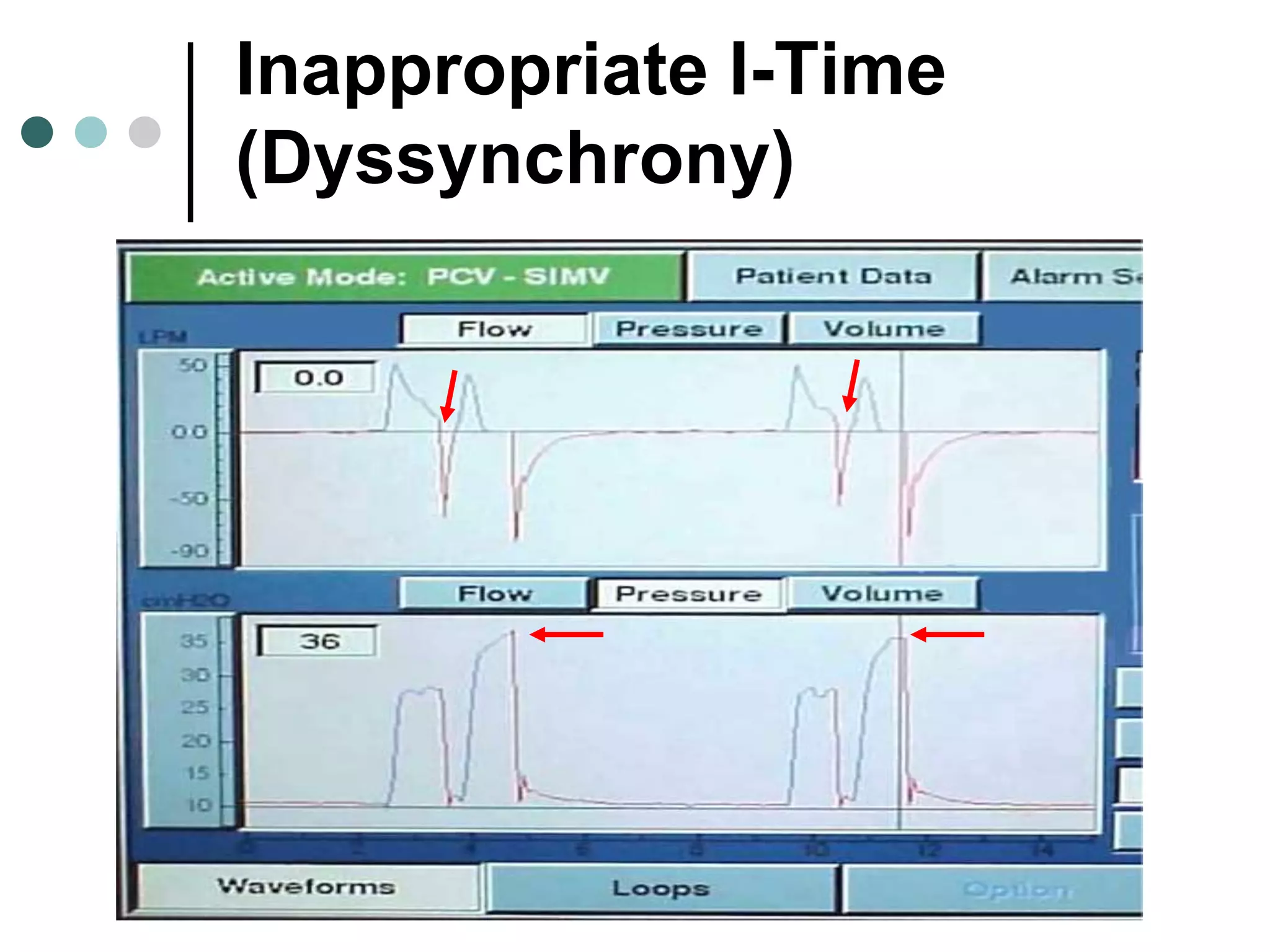 Inappropriate I-Time
(Dyssynchrony)
 