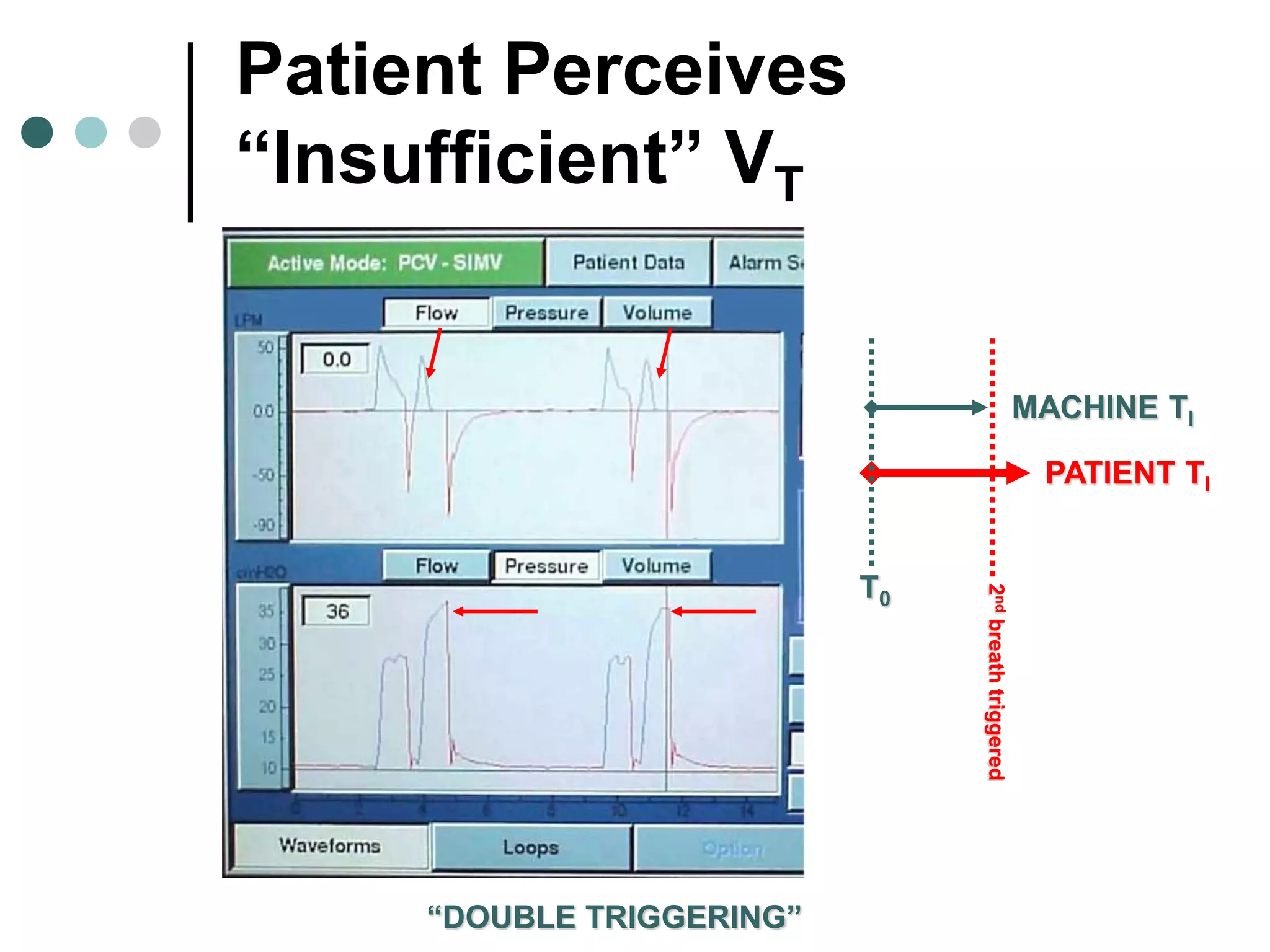 Patient Perceives
“Insufficient” VT
“DOUBLE TRIGGERING”
MACHINE TI
PATIENT TI
T0
2ndbreathtriggered
 
