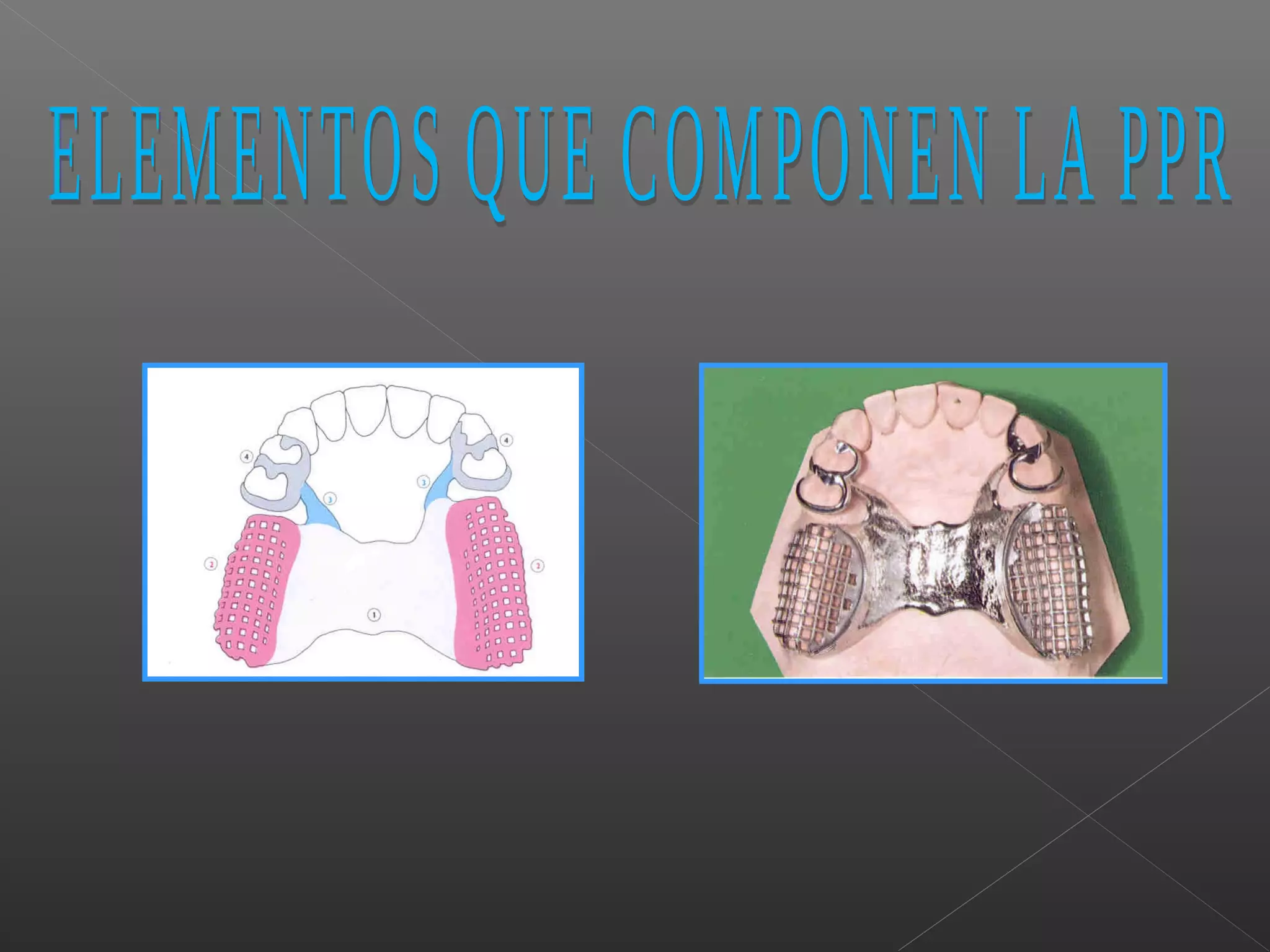 5-ganchos-de-protesis-parcial-removible-ppt