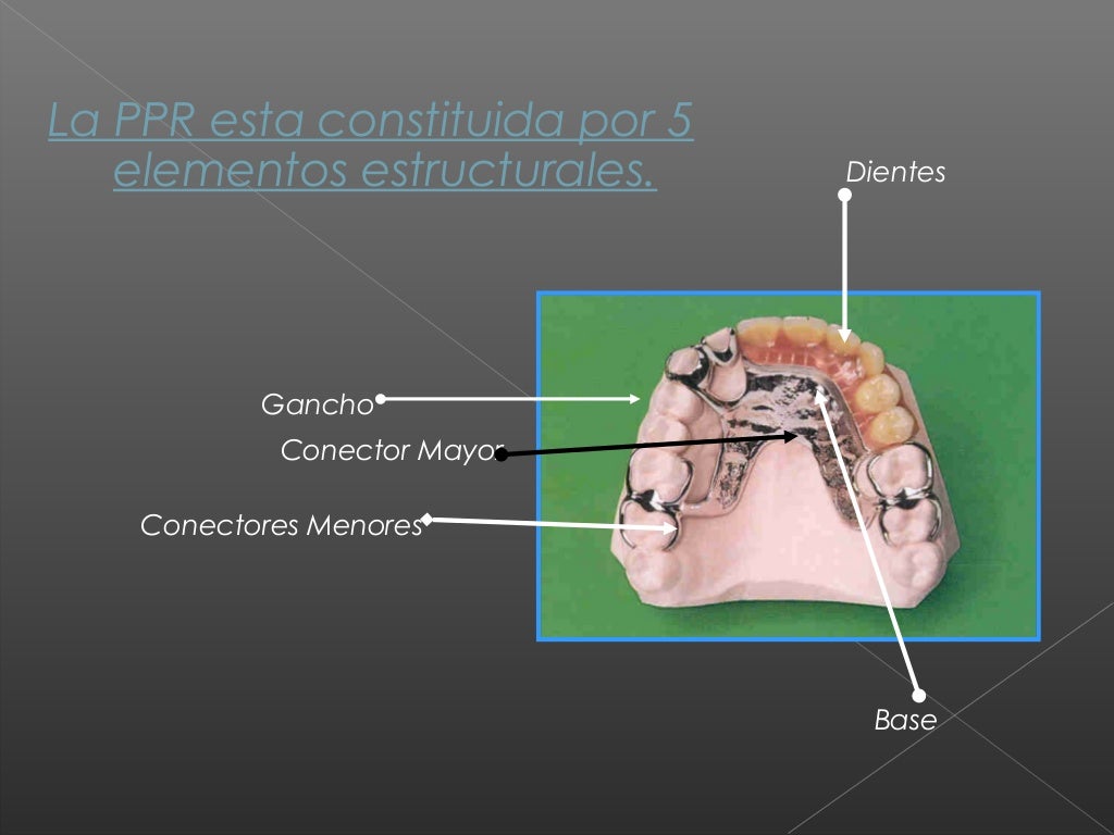 5 ganchos de protesis parcial removible