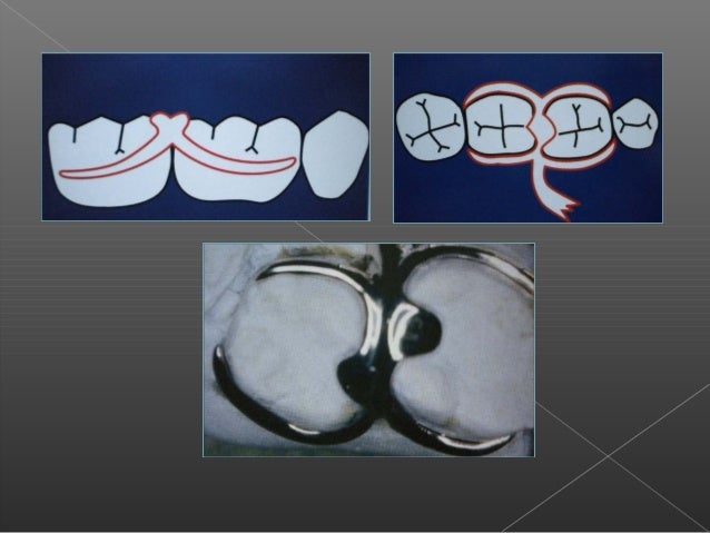 5 ganchos de protesis parcial removible