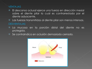 VENTAJAS El descanso oclusal ejerce una fuerza en dirección mesial sobre el diente pilar la cual es contrarrestada por el diente adyacente. Las fuerzas transmitidas al diente pilar son menos intensas. DESVENTAJAS La mucosa en la porción distal del diente no es protegida. Se contraindica en oclusión demasiado cerrada. 