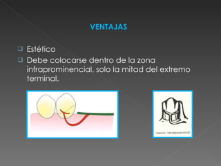 VENTAJAS Estético Debe colocarse dentro de la zona infraprominencial, solo la mitad del extremo terminal. 