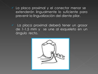 La placa proximal y el conector menor se  extenderán lingualmente lo suficiente para prevenir la lingualización del diente pilar. La placa proximal deberá tener un grosor de 1-1.5 mm y  se une al esqueleto en un ángulo  recto. 