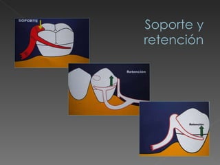 Soporte y  retención 