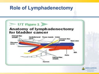 Role of Lymphadenectomy
 