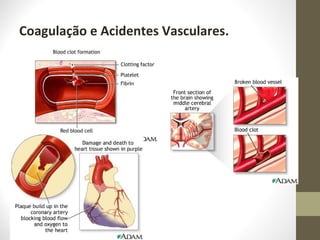 Coagulação e Acidentes Vasculares.
 