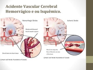 Acidente Vascular Cerebral
Hemorrágico e ou Isquêmico.
 