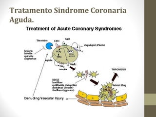 Tratamento Sindrome Coronaria
Aguda.
 