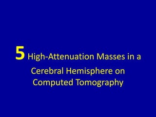 5High-Attenuation Masses in a
Cerebral Hemisphere on
Computed Tomography
 