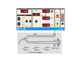 Bias Flow CDP Control Balloon x 