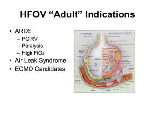 HFOV “Adult” Indications ARDS PCIRV Paralysis High FiO 2   Air Leak Syndrome ECMO Candidates 