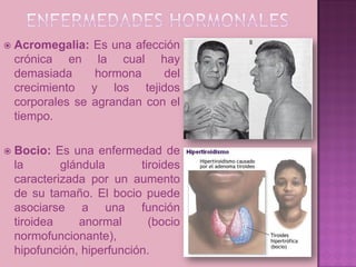    Acromegalia: Es una afección
    crónica en la cual hay
    demasiada     hormona     del
    crecimiento y los tejidos
    corporales se agrandan con el
    tiempo.

   Bocio: Es una enfermedad de
    la       glándula       tiroides
    caracterizada por un aumento
    de su tamaño. El bocio puede
    asociarse a una función
    tiroidea    anormal       (bocio
    normofuncionante),
    hipofunción, hiperfunción.
 