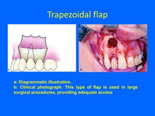 Trapezoidal flap
a: Diagrammatic illustration.
b: Clinical photograph. This type of flap is used in large
surgical procedures, providing adequate access
 