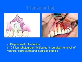 Triangular flap
a: Diagrammatic illustration.
b: Clinical photograph. Indicated in surgical removal of
root tips, small cysts and in apicoectomies
 