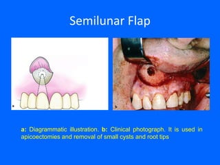 Semilunar Flap
a: Diagrammatic illustration. b: Clinical photograph. It is used in
apicoectomies and removal of small cysts and root tips
 