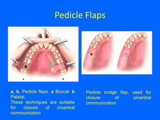 Pedicle Flaps
a, b. Pedicle flaps. a Buccal. b
Palatal.
These techniques are suitable
for closure of oroantral
communication
Pedicle bridge flap, used for
closure of oroantral
communication
 