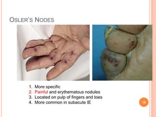 5 infective endocarditis | PPT