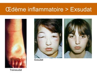 Œdème inflammatoire > Exsudat Transsudat Exsudat 