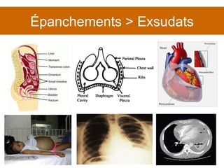 Épanchements > Exsudats 