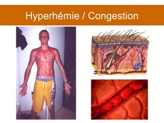 Hyperhémie / Congestion 