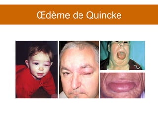 Œdème de Quincke 