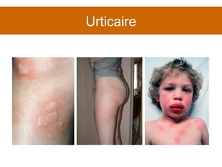 Urticaire 
