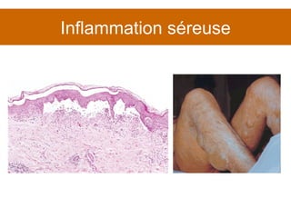 Inflammation séreuse 