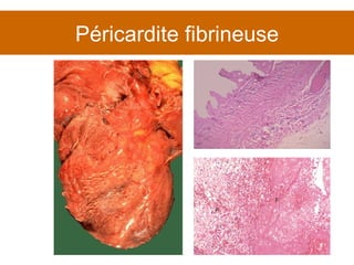 Péricardite fibrineuse 