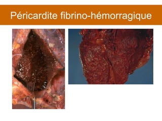 Péricardite fibrino-hémorragique 