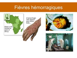 Fièvres hémorragiques 