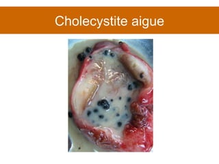 Cholecystite aigue 
