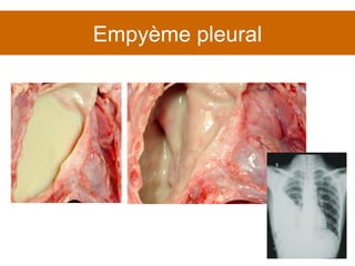 Empyème pleural 