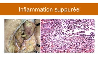 Inflammation suppurée 