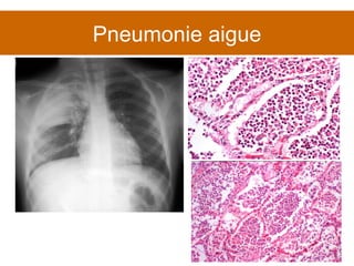 Pneumonie aigue 