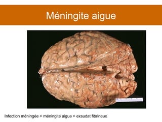 Méningite aigue Infection méningée > méningite aigue > exsudat fibrineux 