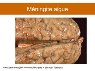Méningite aigue Infection méningée > méningite aigue > exsudat fibrineux 